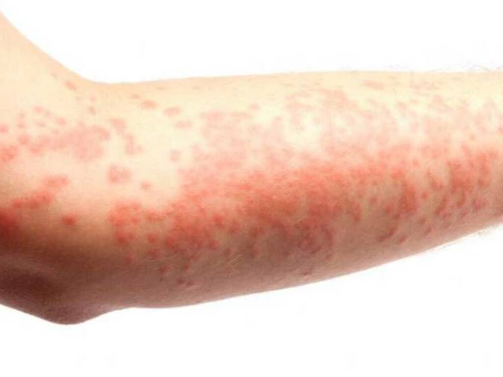 orticaria