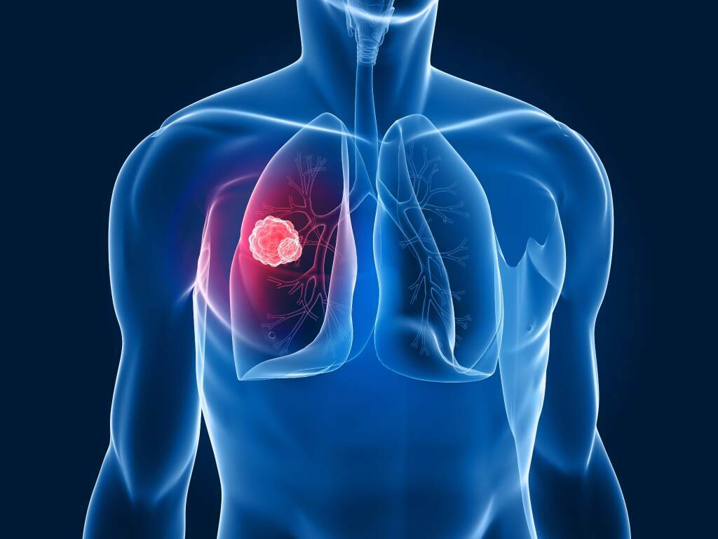 tumore al polmone 